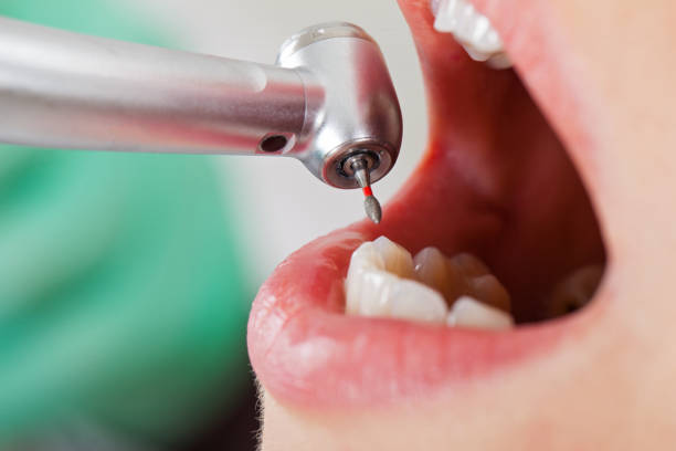 Best Emergency Wisdom Teeth Removal in Frazier Park, CA